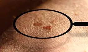 آنتی‌اکسیدان موجب توسعه تومور بدخیم می‌شود