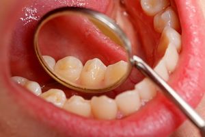 از سرطان دهان چه می دانید ؟+ علل و راه های درمان