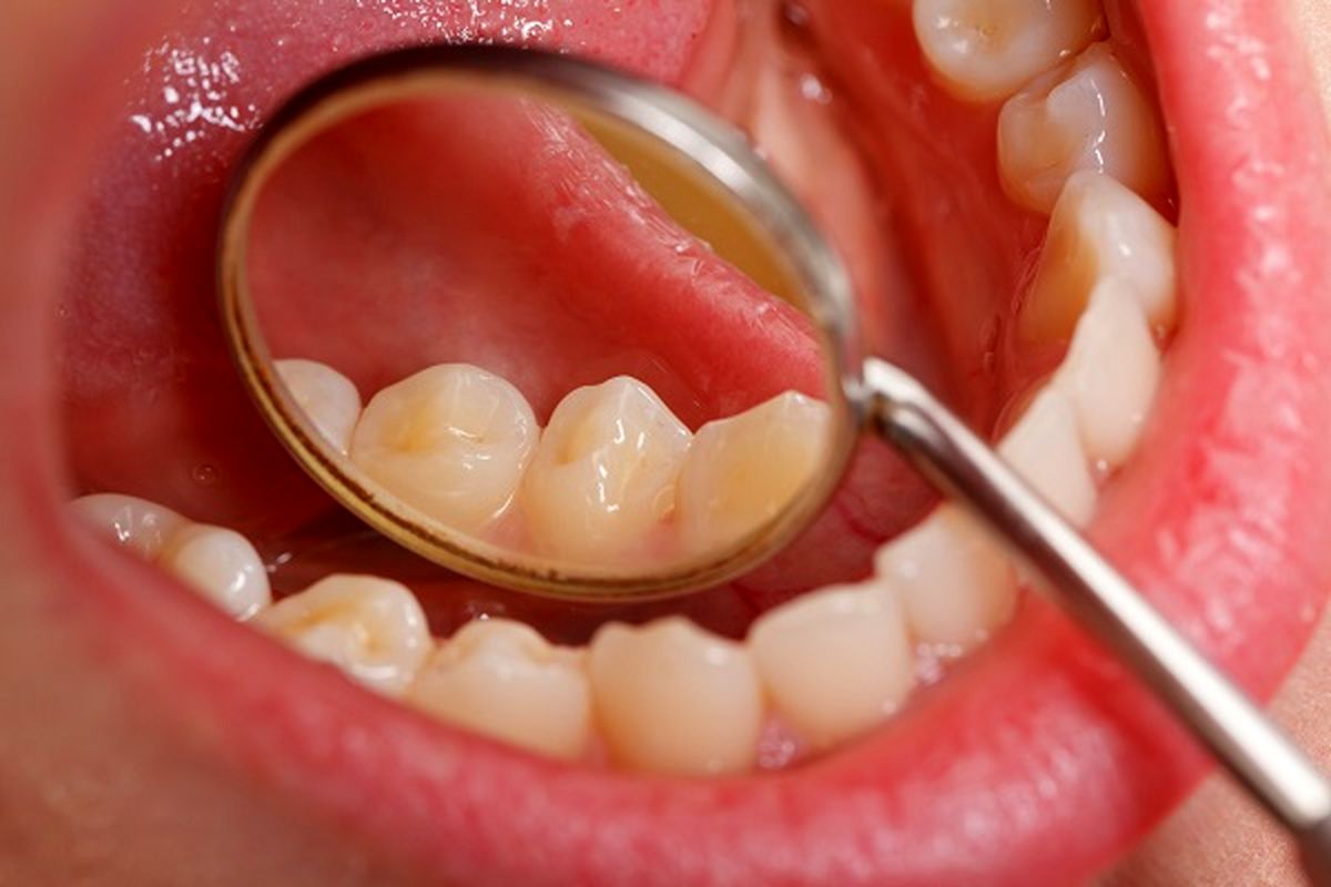 از سرطان دهان چه می دانید ؟+ علل و راه های درمان
