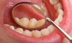 از سرطان دهان چه می دانید ؟+ علل و راه های درمان