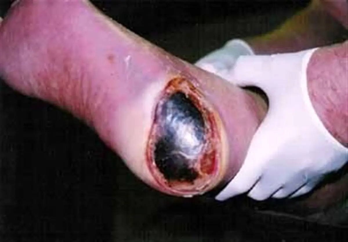 بیشترین مرگ و میر و ناتوانی بر اثر ۴ بیماری/چند درصد ایرانی‌ها در مرحله پره دیابت هستند