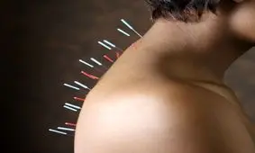 دليل اثر طب سوزنى