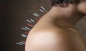 دليل اثر طب سوزنى