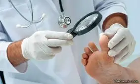 درمان زخم پای دیابتی در 21 روز