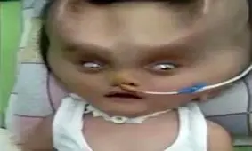 تولد یک نوزاد با بیماری نادر + فیلم