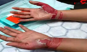 عجیب ترین دلیل کنده شدن پوست دستان دختر 19 ساله !+عکس