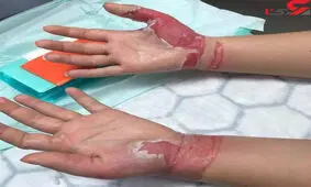 عجیب ترین دلیل کنده شدن پوست دستان دختر 19 ساله !+عکس