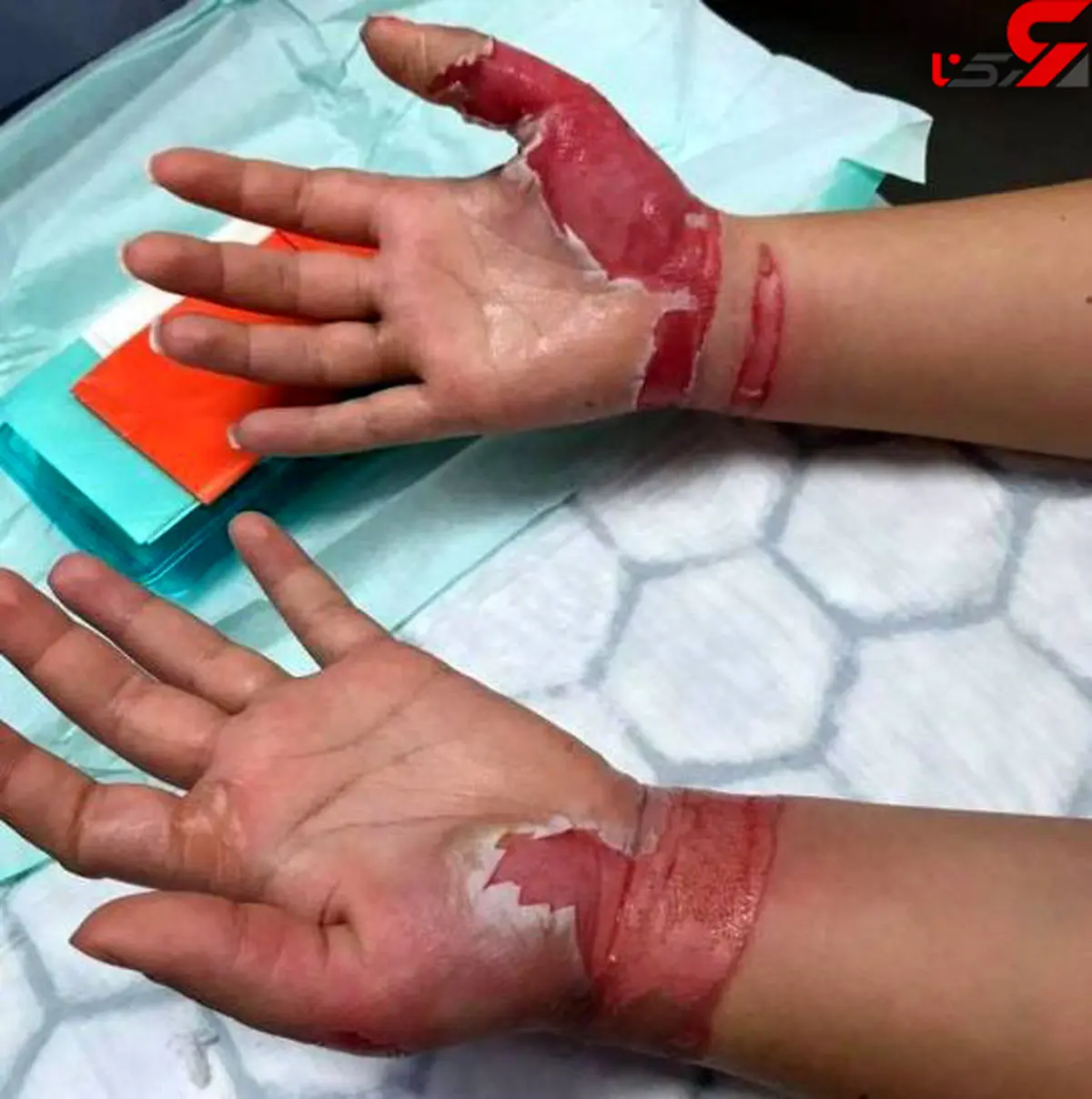 عجیب ترین دلیل کنده شدن پوست دستان دختر 19 ساله !+عکس