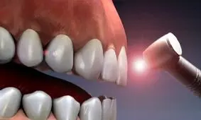 یکبار برای همیشه، همه آن چیزی که درباره ایمپلنت لیزری لازم است بدانید