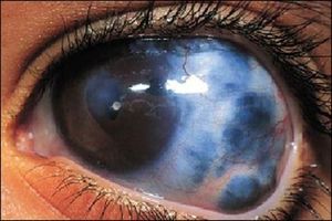 علل اصلی کم بینایی و نابینایی در جهان چیست؟
