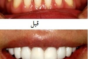 آنچه درباره ی لمینت دندان باید بدانیم