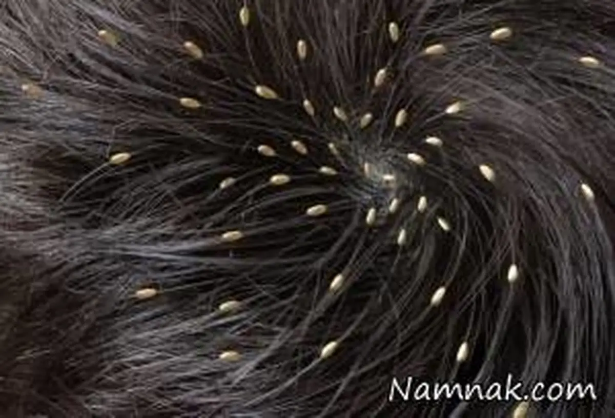 نشانه هایی که به شما می گوید شپش دارید!