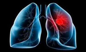 ۱۰ هشدار که خبر از ضعیف شدن ریه‌ها می‌دهد