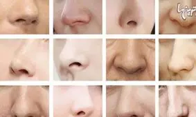 جراحی زیبایی بینی و انواع آن
