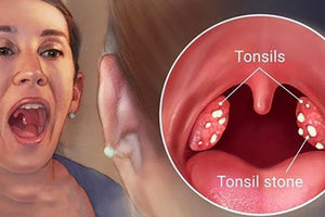 علل، علائم و درمان سنگ لوزه چیست؟