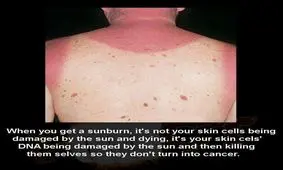 آفتاب سوختگی، خودکشی سلولهاست !