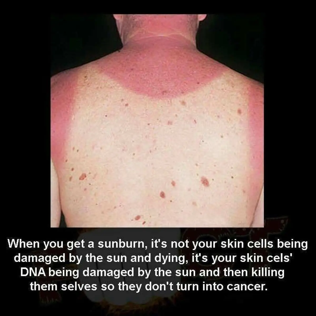 آفتاب سوختگی، خودکشی سلولهاست !