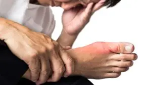 چرا به نقرس مبتلا می شویم