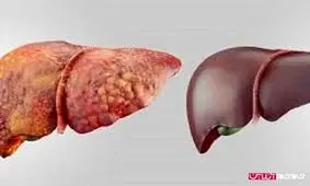 راه های مقابله با کبد چرب