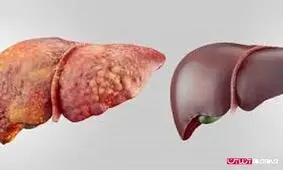 راه های مقابله با کبد چرب