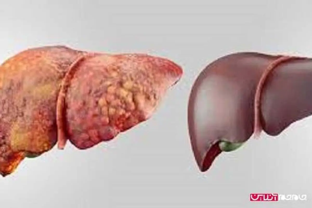 راه های مقابله با کبد چرب