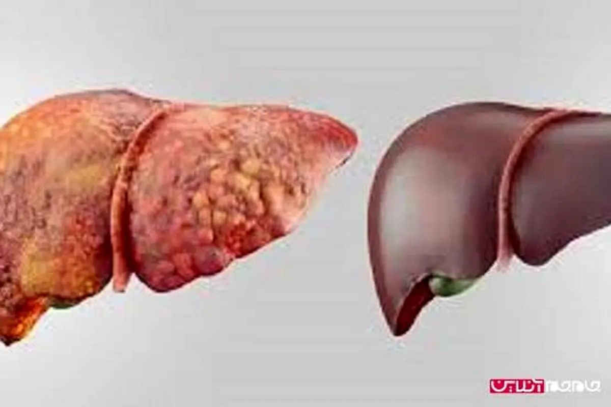 راه های مقابله با کبد چرب