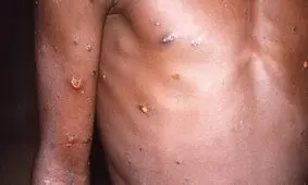 هشدار کارشناسان و نگرانی بایدن از شیوع آبله میمون/ آیا احتمال انتقال با رابطه جنسی هم وجود دارد؟