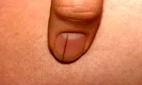 خطوط مشکی ناخن نشانه چیست؟