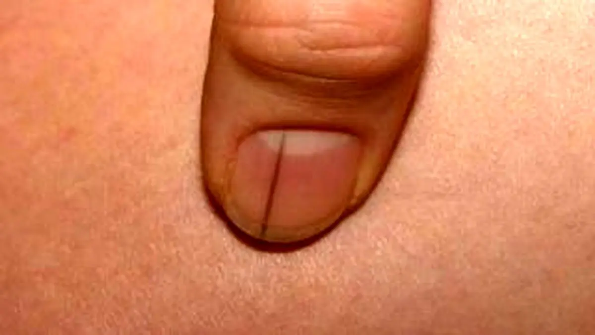 خطوط مشکی ناخن نشانه چیست؟