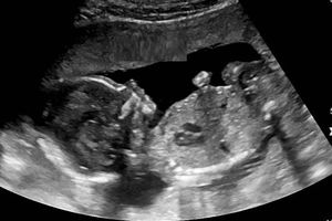 غربالگری نوزاد؛ آزمایش ضروری در بارداری