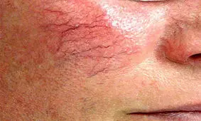 واریس صورت چیست؟ دلایل و راههای درمان