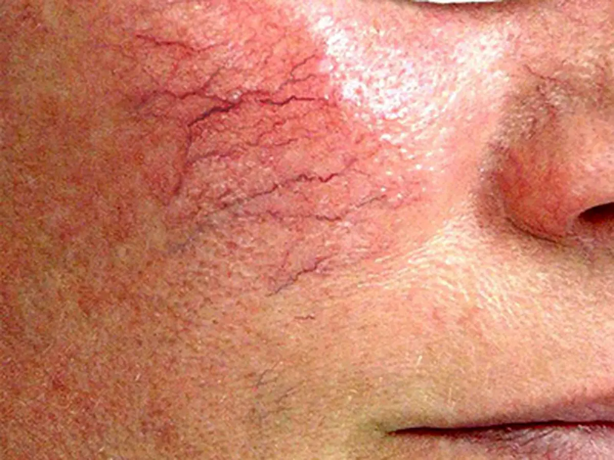 واریس صورت چیست؟ دلایل و راههای درمان