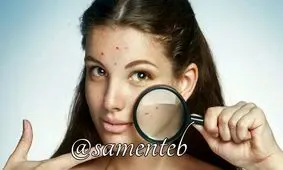 درمان جوش زیرپوستی