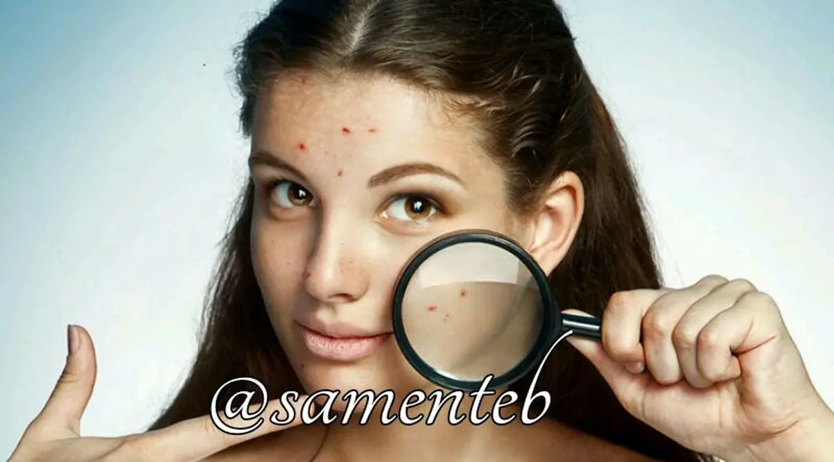 درمان جوش زیرپوستی