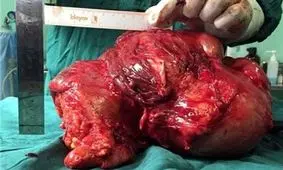 خروج تومور 5 کیلویی خطرناک از صورت مرد 45 ساله
