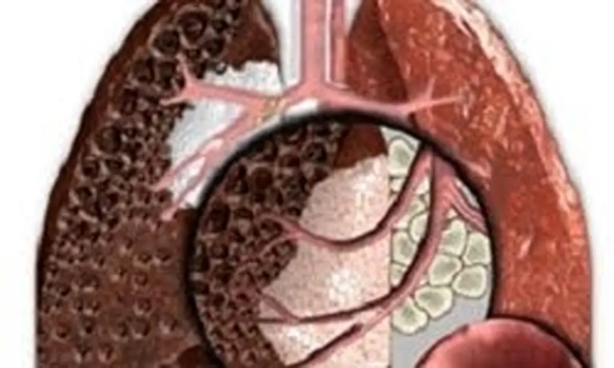 از هر 10 فرد مبتلا به سرطان ریه، 9 نفر مصرف‌کننده