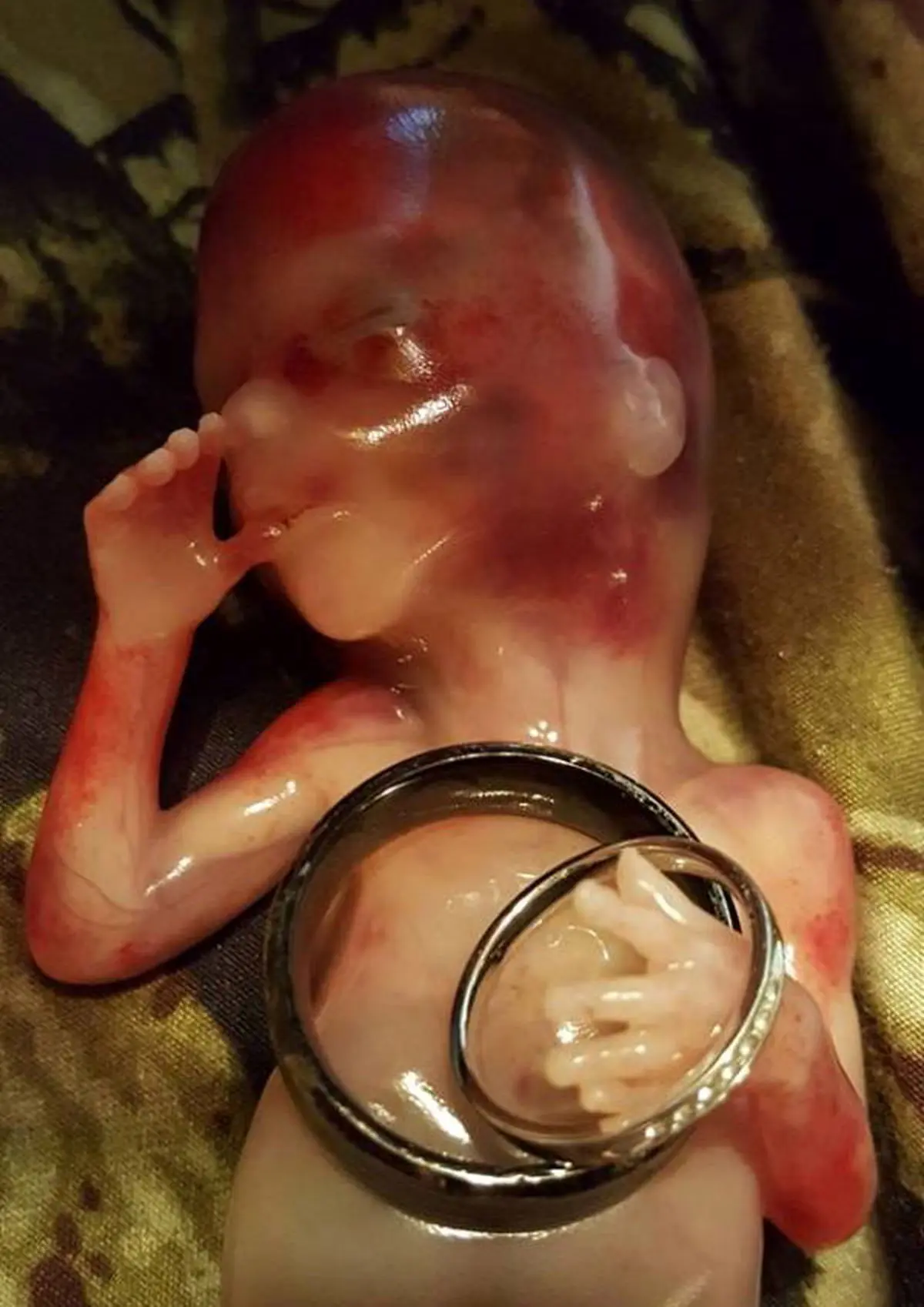 ماجرای دلخراش سقط جنین 14 هفته ای (عکس)