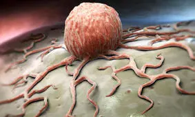 مرگبارترین سرطان در ایران چیست؟