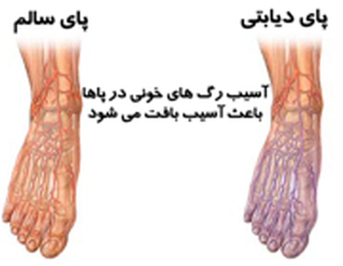 هر ۱۹ ثانیه در جهان، پای یک دیابتی قطع می‌شود‌