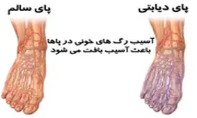 هر ۱۹ ثانیه در جهان، پای یک دیابتی قطع می‌شود‌