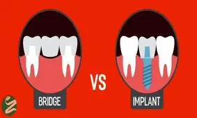 ایمپلنت و بریج دندان چه تفاوت هایی دارند؟