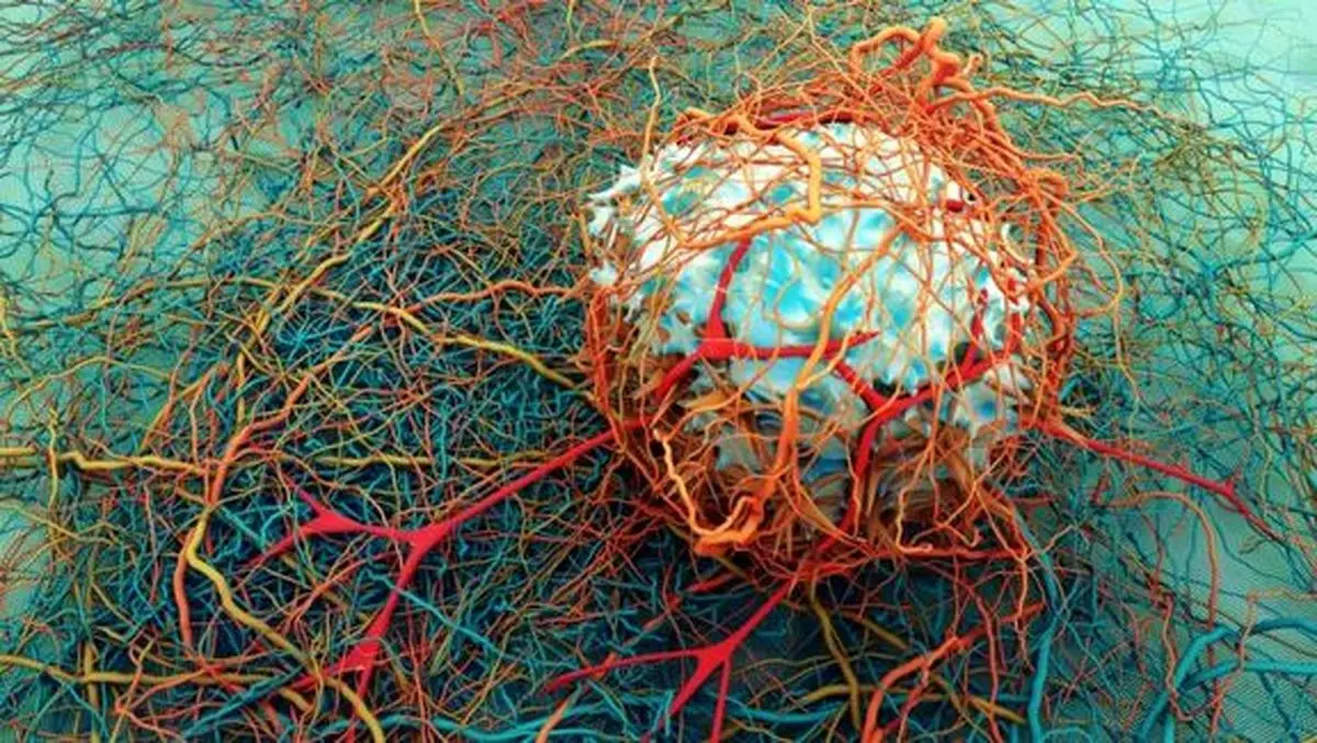 تشخیص سریع و کم‌هزینه متاستاز سرطان پروستات