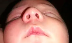 روش جراحی سپتو پلاستی