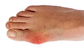 همه چیز درباره بیماری نقرس +اینفوگرافیک