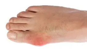 همه چیز درباره بیماری نقرس +اینفوگرافیک