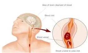 چگونه عوارض بعد از سکته مغزي را کاهش دهيم