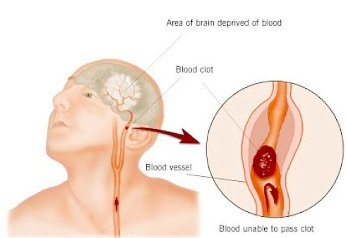 چگونه عوارض بعد از سکته مغزي را کاهش دهيم