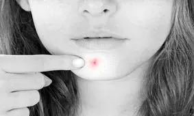 علت جوش چانه چیست و چگونه درمان می‌شود؟