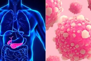 سرطان پانکراس چیست؟؛ علت، علائم و راه های درمان