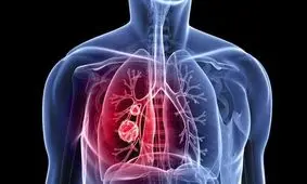 علت و علائم پنومونی در کودکان چیست و چگونه درمان می‌شود؟